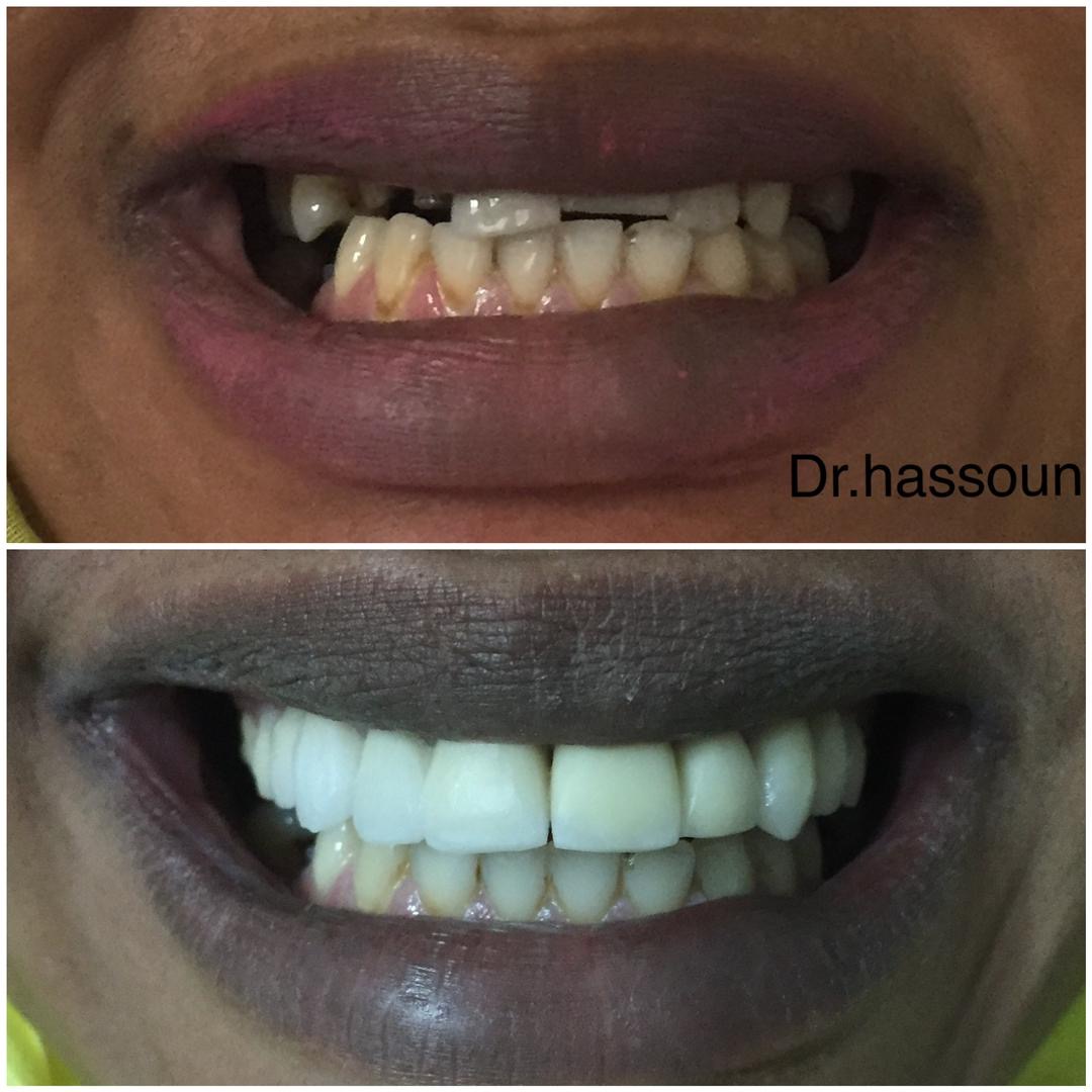 Prosthetic Crowns & Bridges