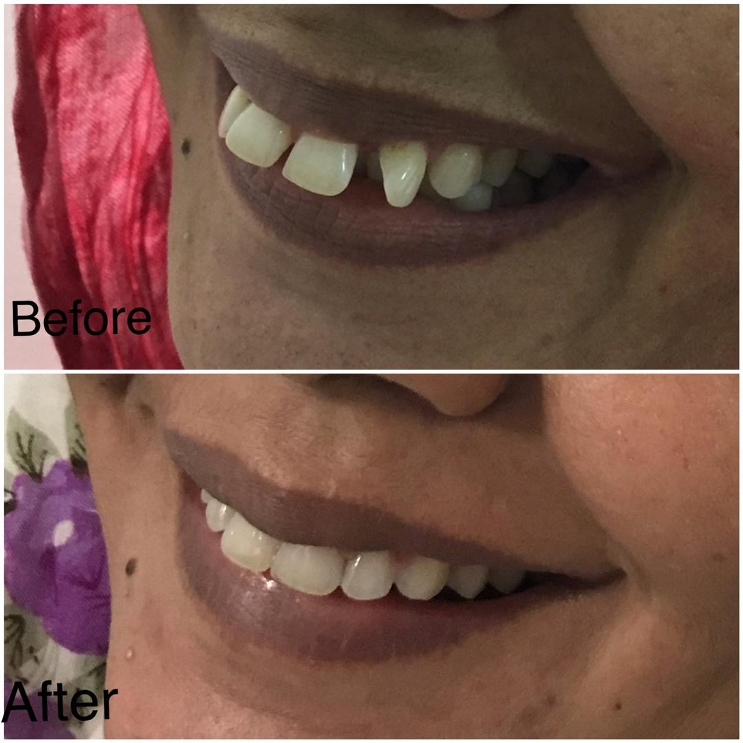 Cosmetic Dentistry & Veneers