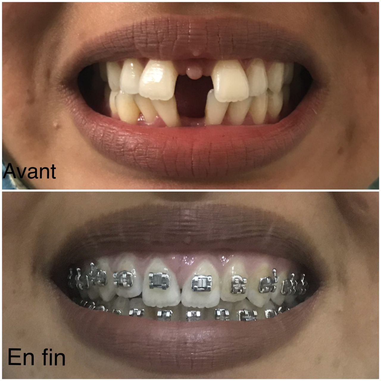 Orthodontic Treatment with Braces