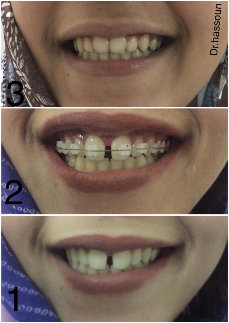 Diastema Closure with Orthodontics