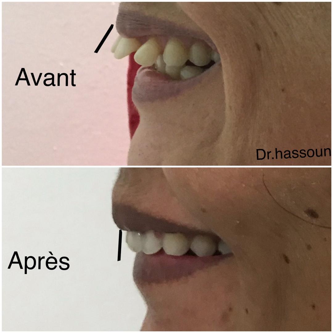 Orthodontic Alignment — Profile View