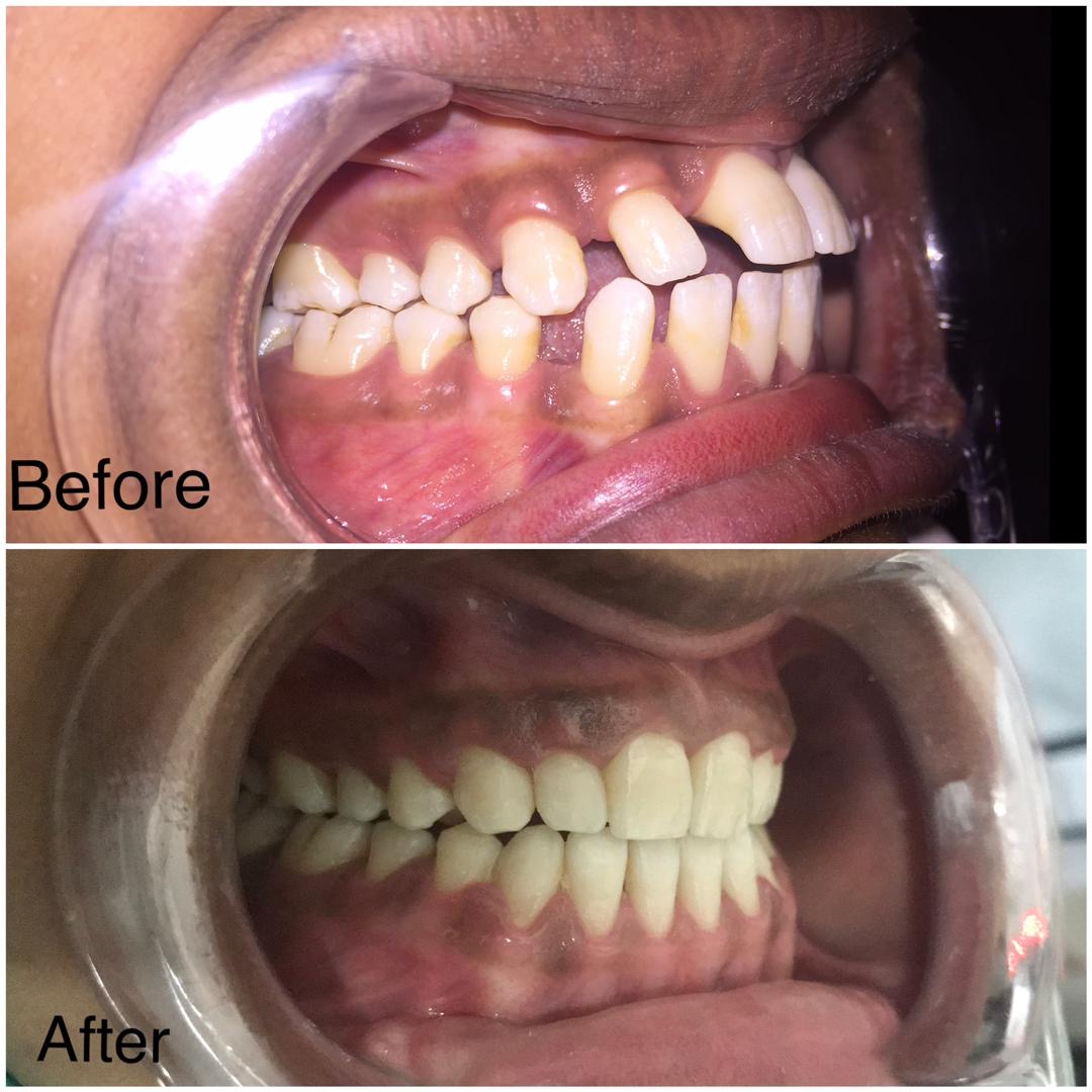 Severe Malocclusion Treatment