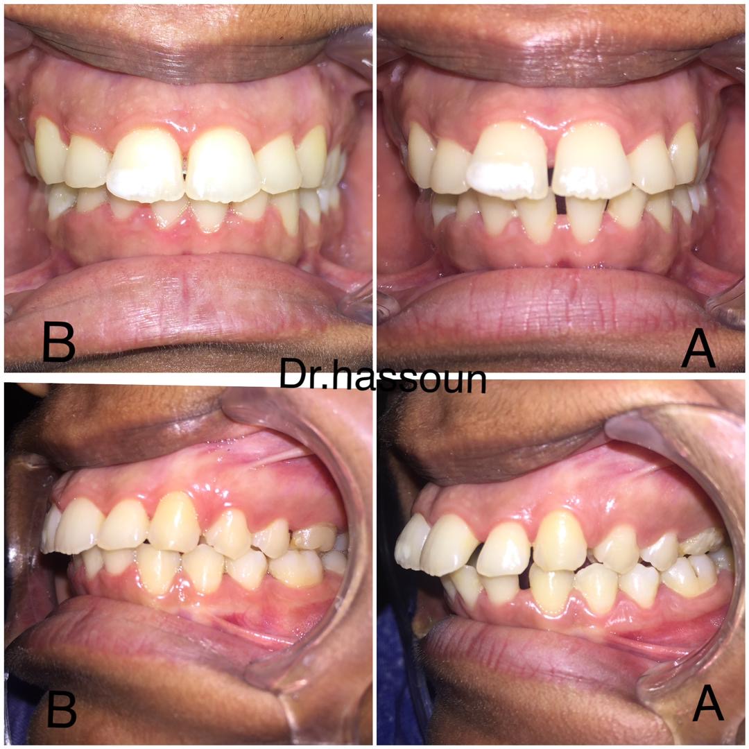 Malocclusion & Crowding Correction