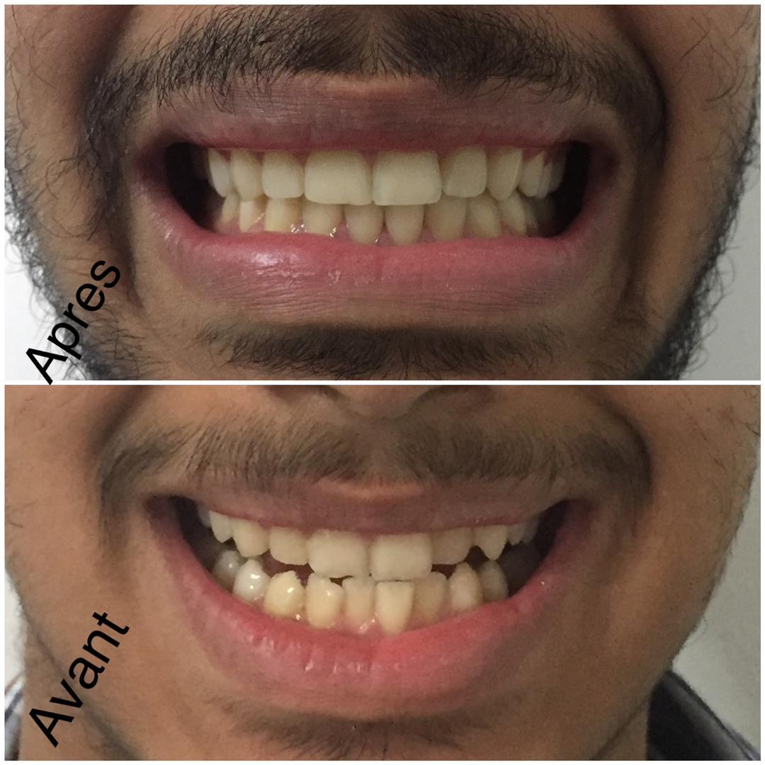 Aesthetic Smile Restoration