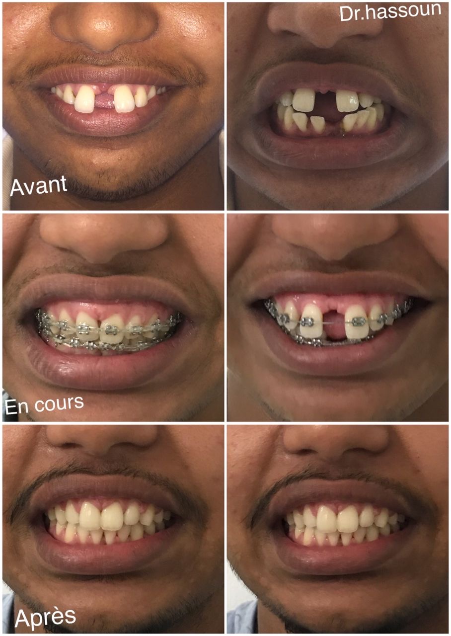 Complete Smile Rehabilitation