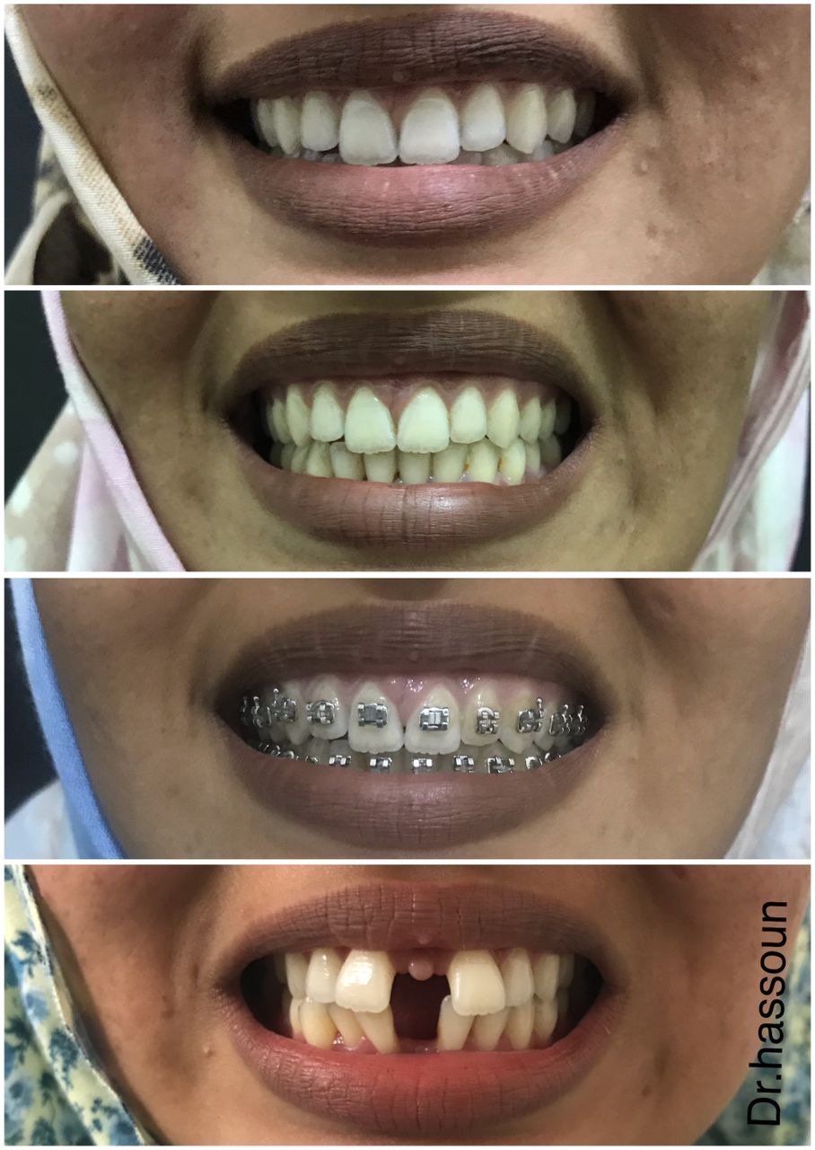 Full Orthodontic Journey